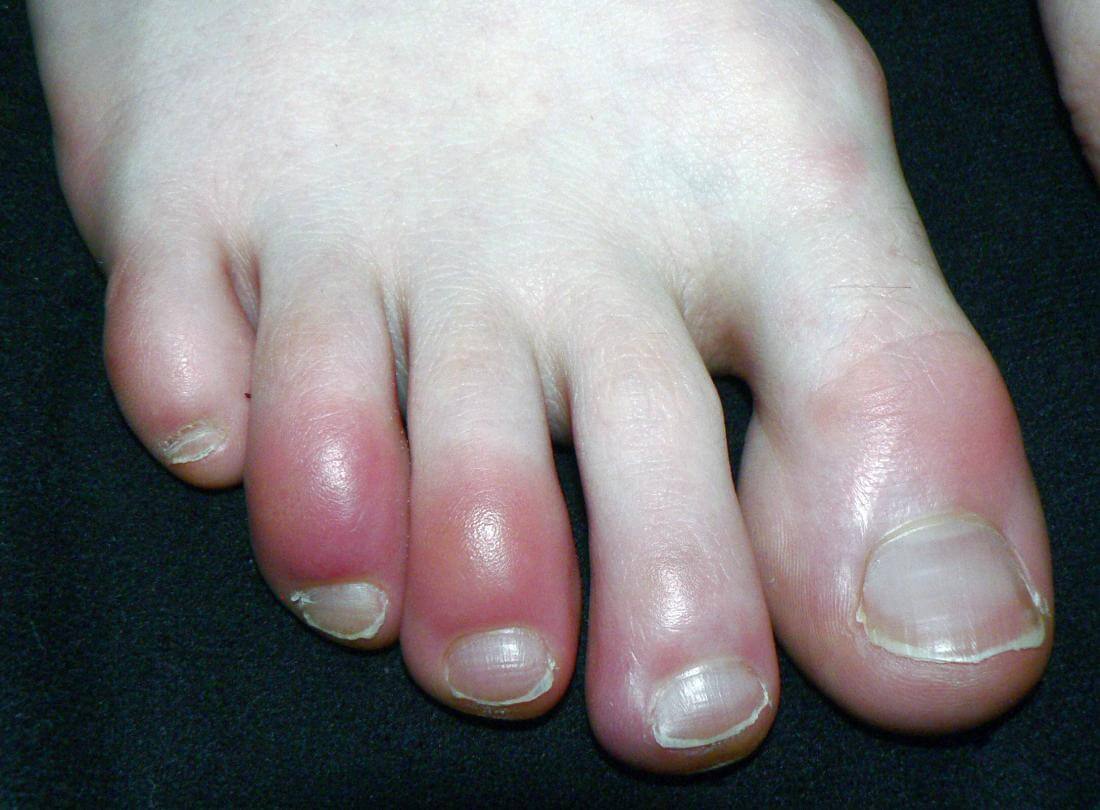 What are Chilblains?