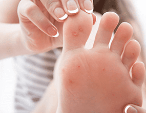 Corns and Calluses