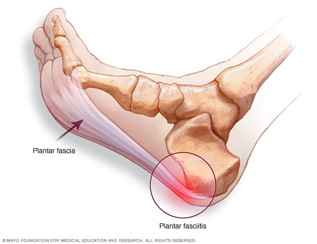 Plantar Fasciitis Orthotics